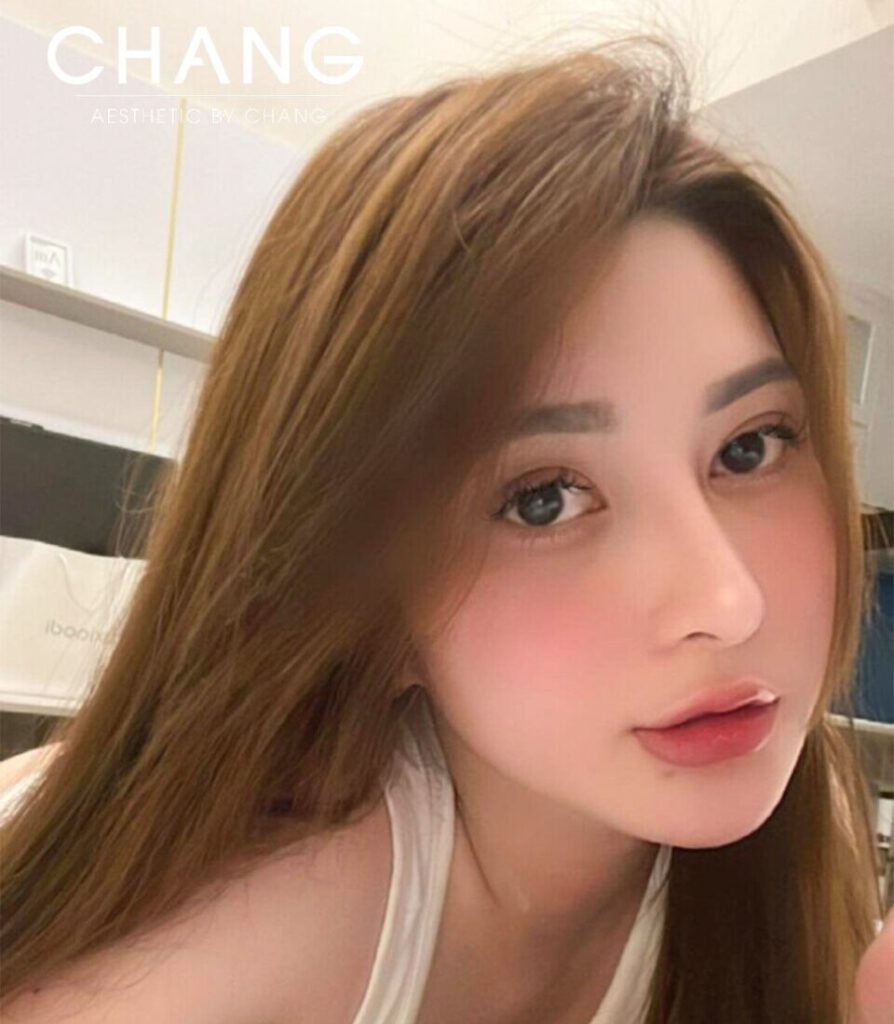 Mở góc mắt trunng hoa