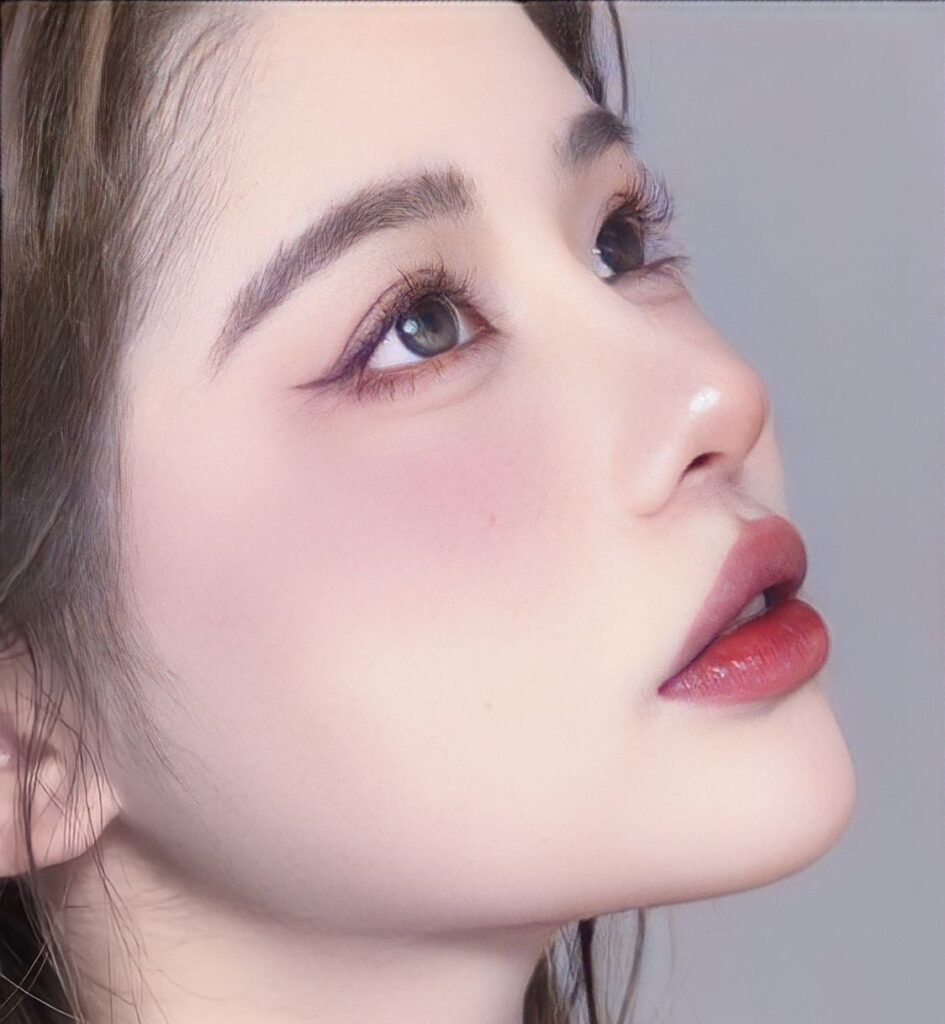 Chi phí độn cằm