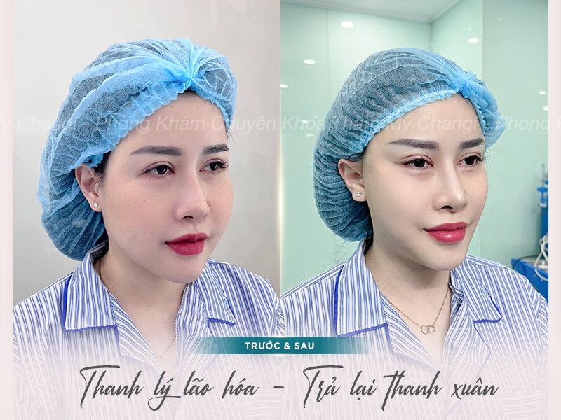 Hiệu quả trước sau Căng Cơ Nội Soi