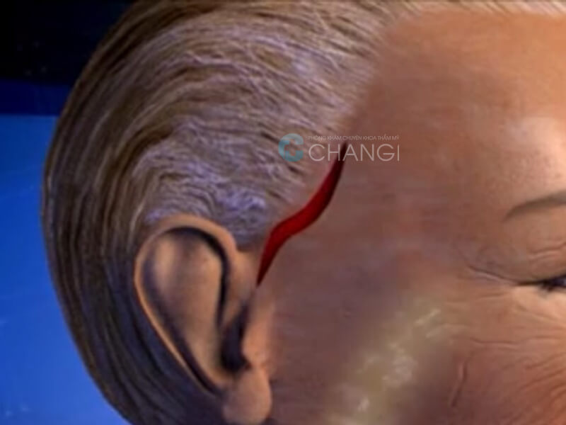 căng da thái dương ngoại khoa