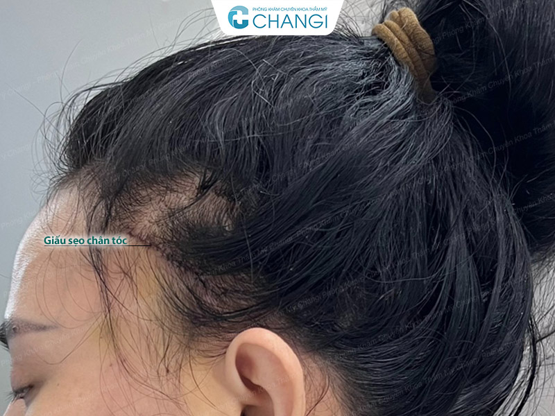 Căng cơ nội soi giấu sẹo trong chân tóc