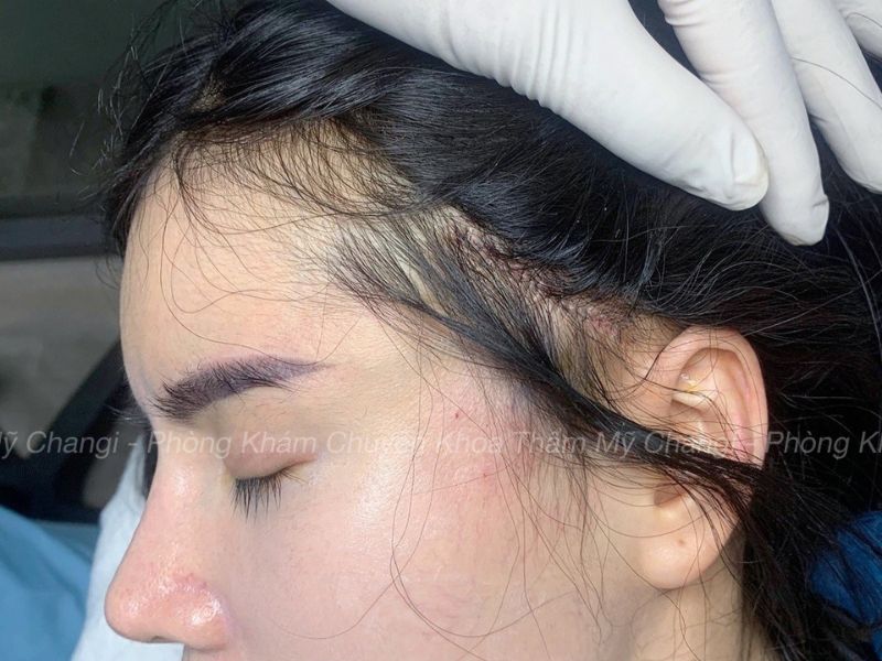 Căng Cơ Nội Soi giấu sẹo trong chân tóc