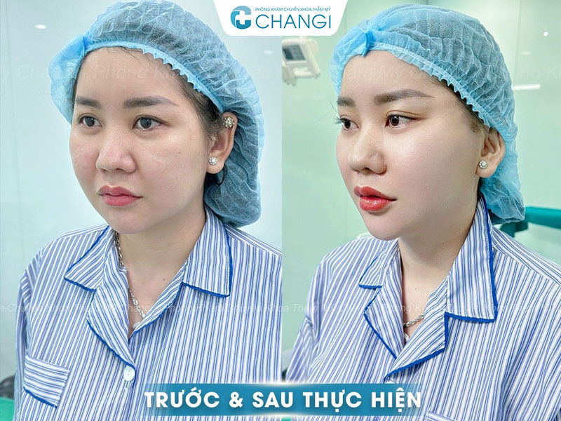 Hiệu quả của căng cơ nội soi