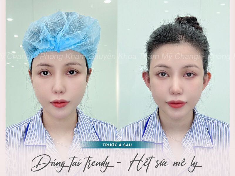 Trước và sau khi thực hiện Tạo Hình Tai Vểnh