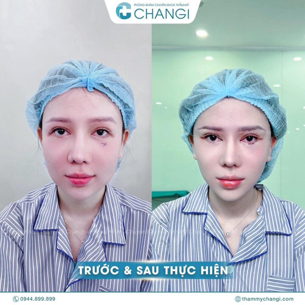 Chị N.M sau khi <yoastmark class=