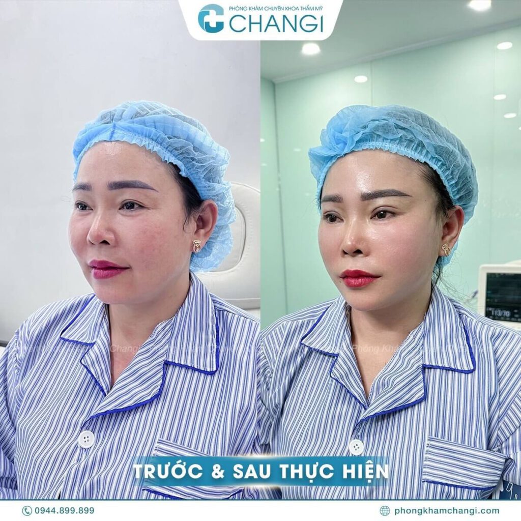 Cô V.T sau khi căng cơ nội soi