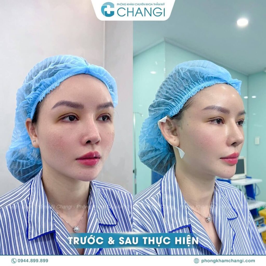 Chị N.V sau khi căng cơ nội soi