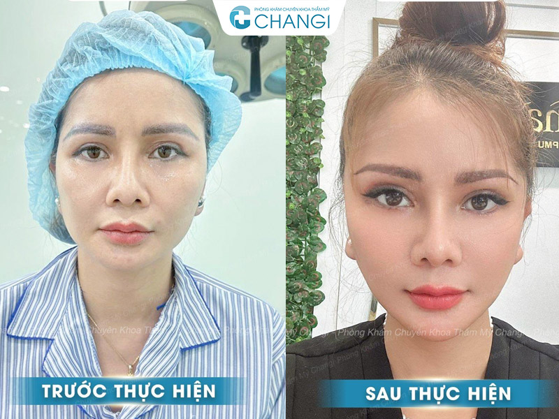 Khách hàng của CHANGI sau 1 năm căng cơ nội soi
