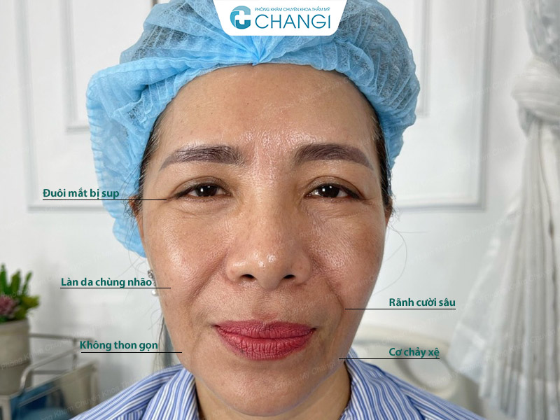 Những vị trí căng cơ nội soi có thể giải quyết