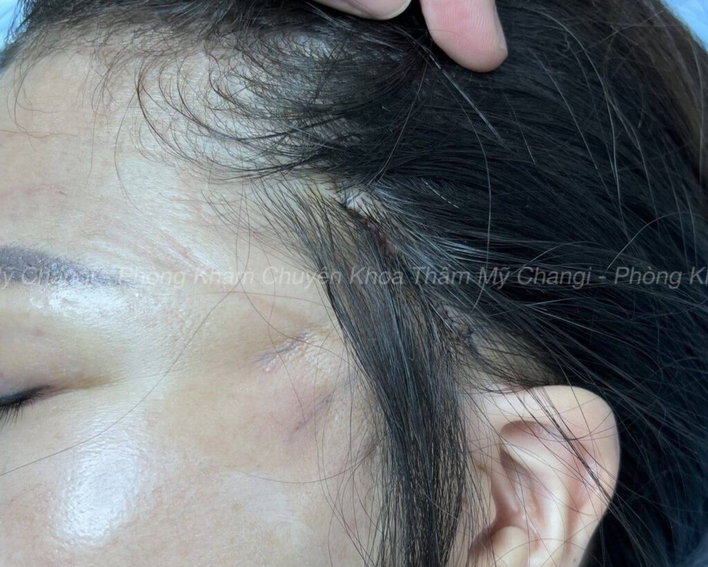 căng cơ nội soi giấu sẹo trong chân tóc