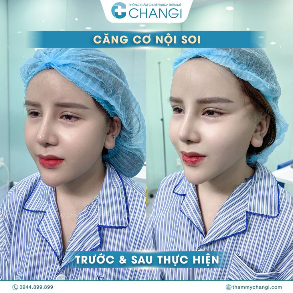 hiệu quả của căng cơ nội soi