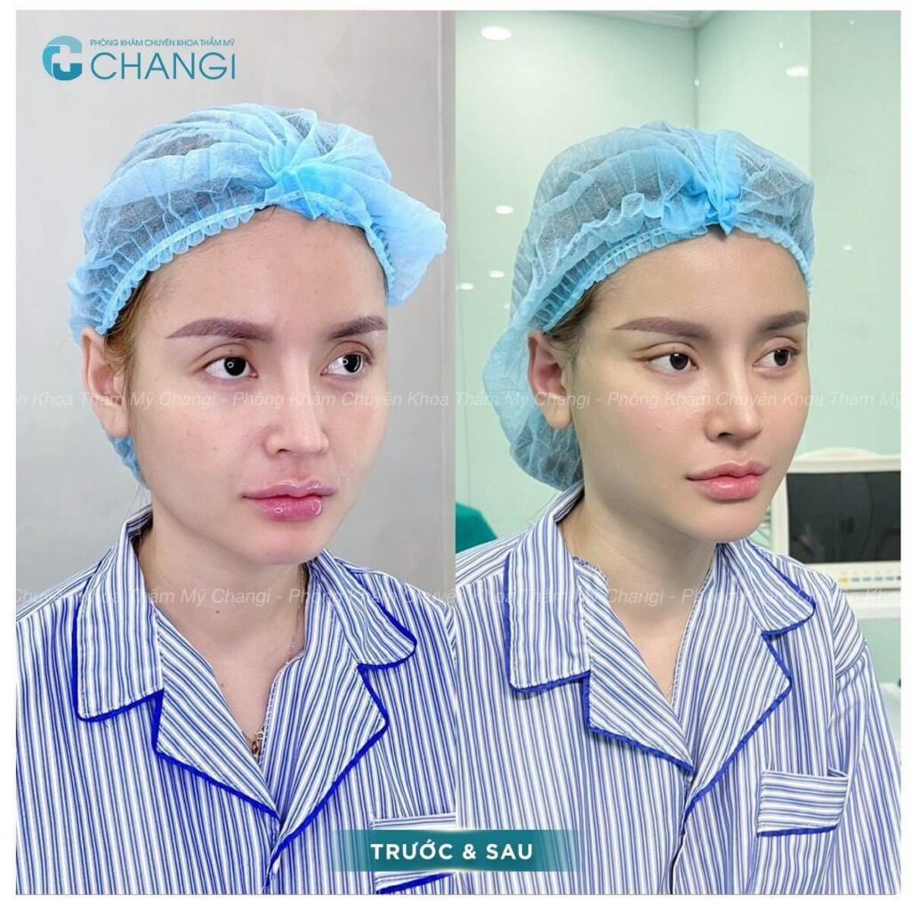 khách hàng căng cơ nội soi