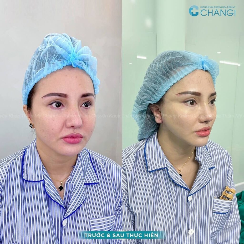 khách hàng căng cơ nội soi