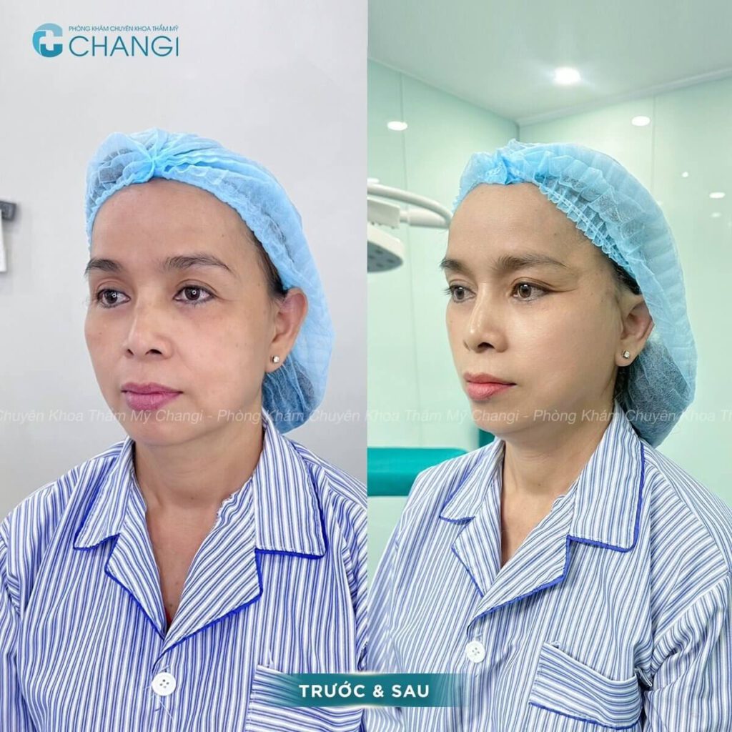 khách hàng căng cơ nội soi