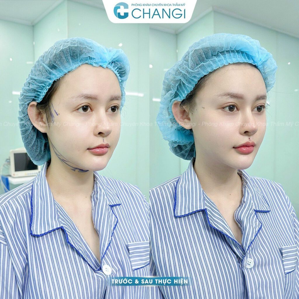 hiệu quả của căng cơ nội soi