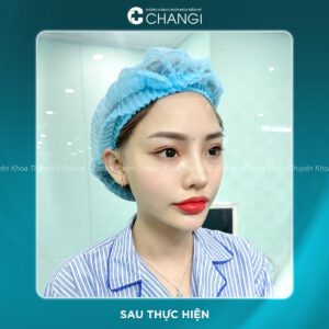 Sau khi căng cơ nội soi giúp mặt không bị chảy xệ