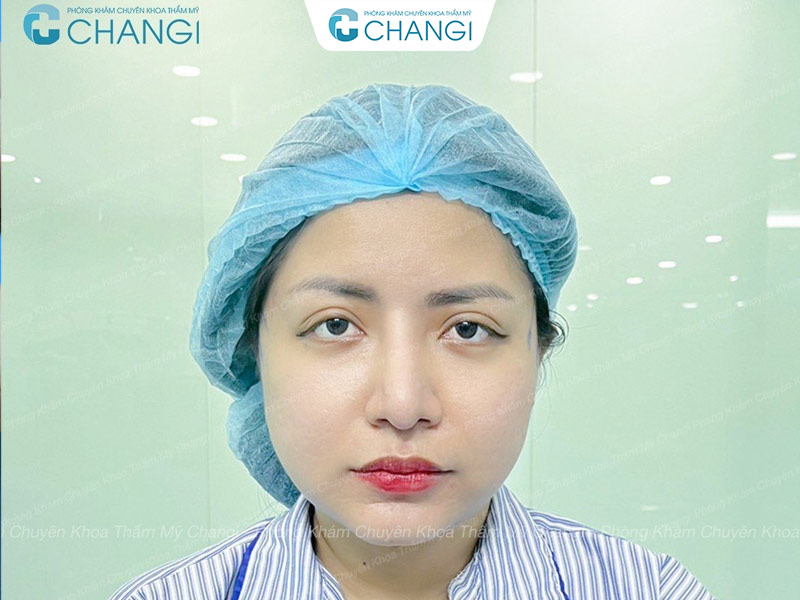 căng cơ nội soi dành cho tình trạng da như thế này