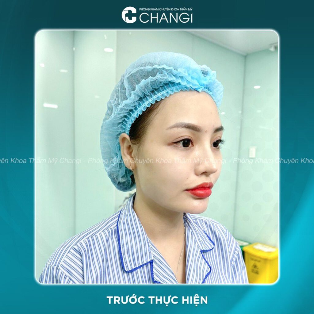 trước khi căng cơ nội soi