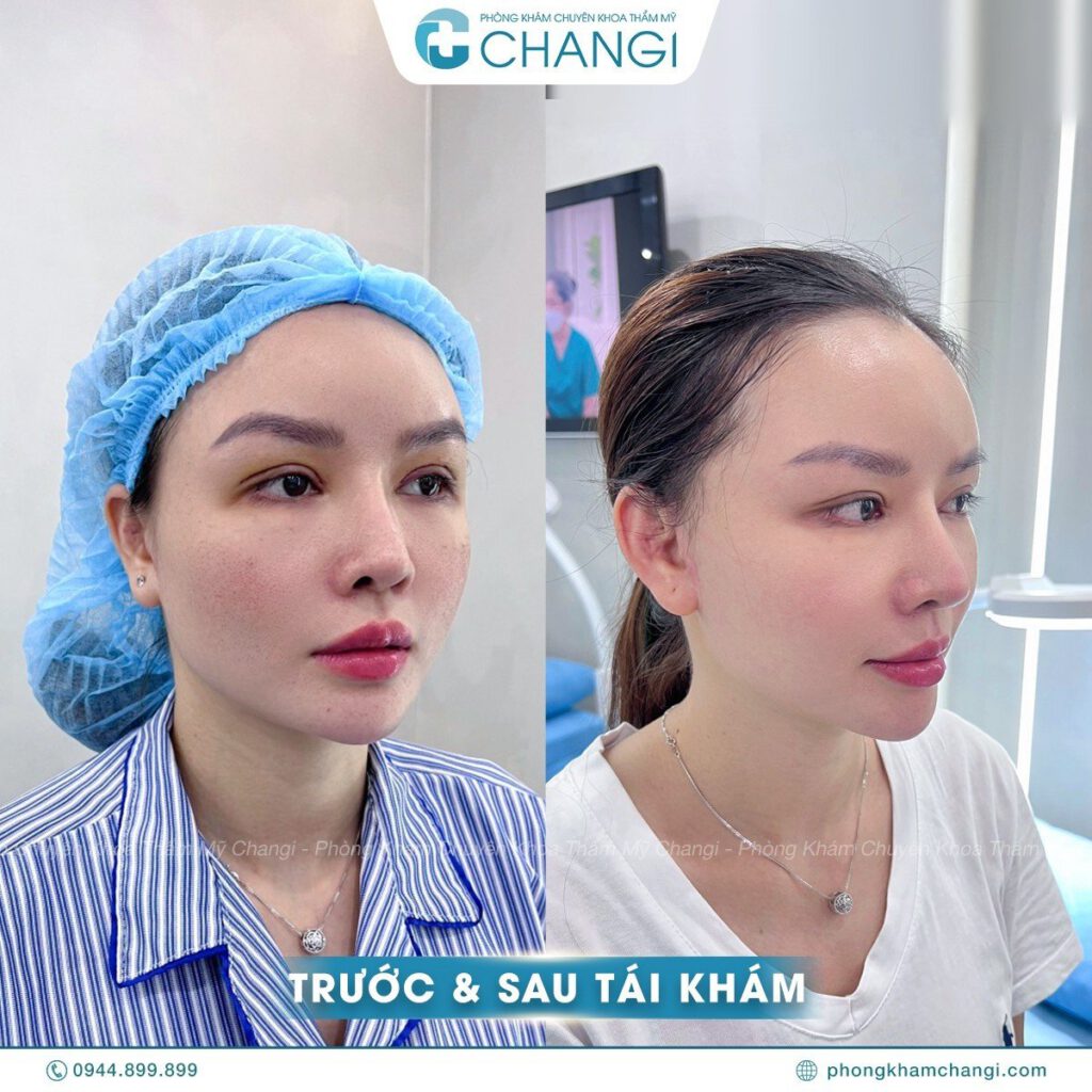 Trước và sau khi căng cơ nội soi tại CHANGI