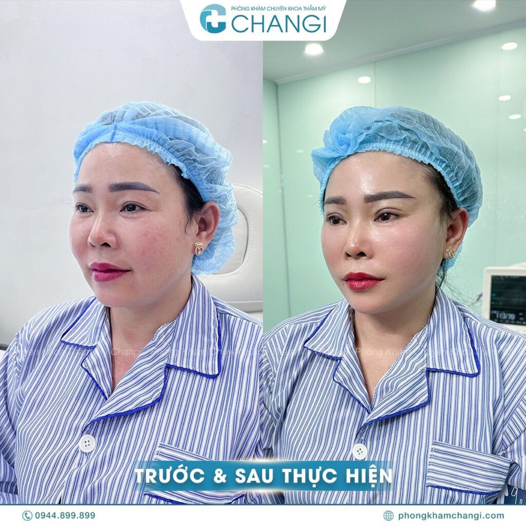 Khách hàng trước và sau khi căng cơ nội soi