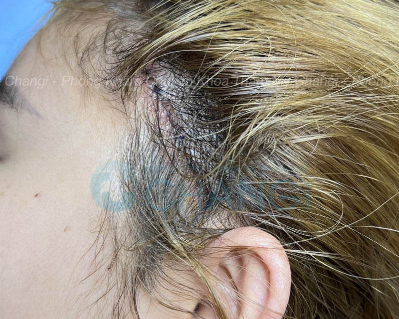 Vết thương căng cơ nội soi sau 7 ngày