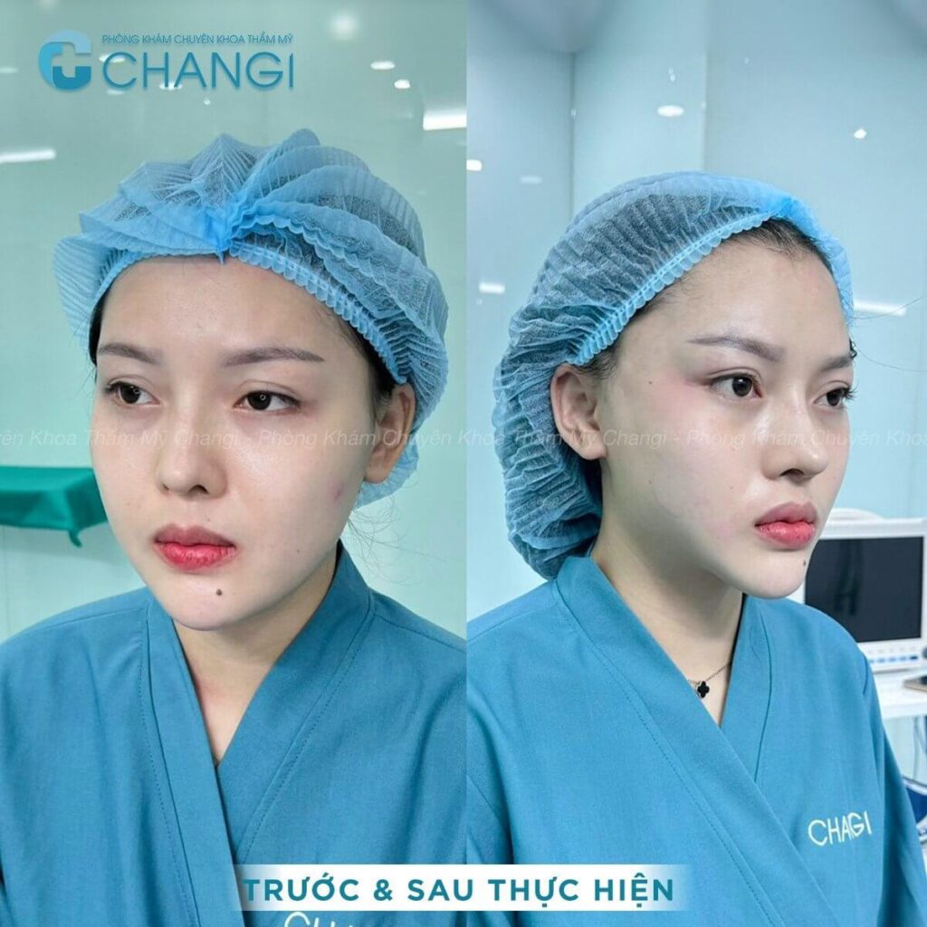 Hiệu quả nhờ căng cơ nội soi