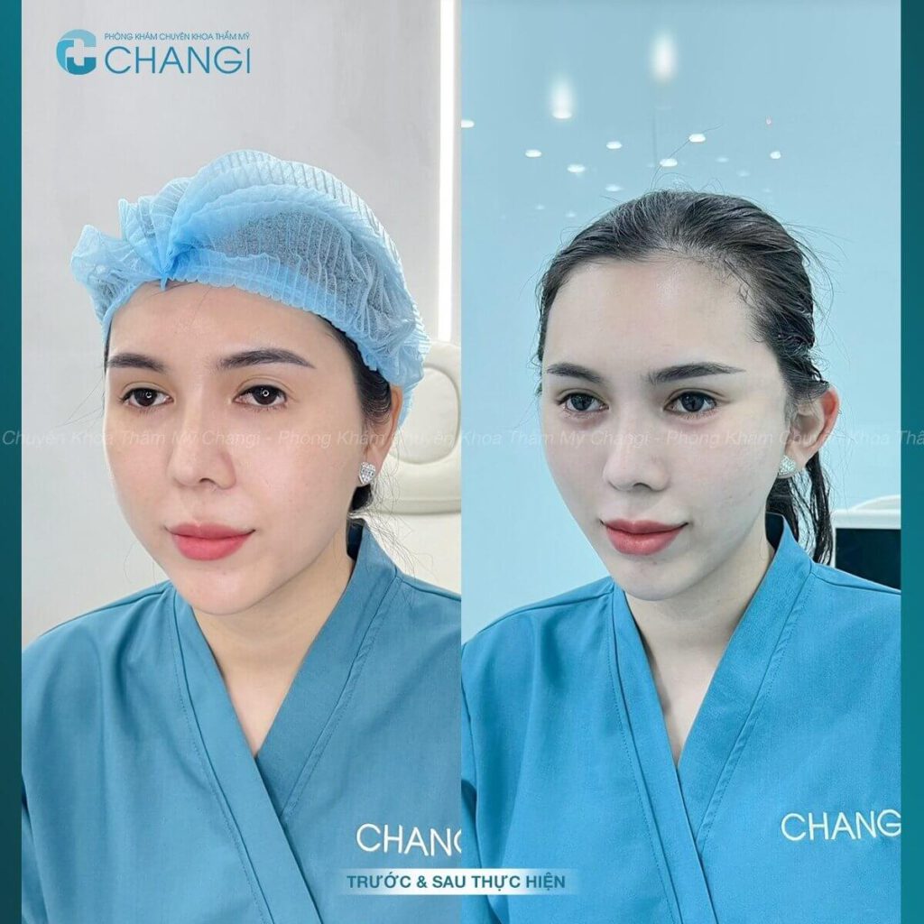 Hiệu quả của căng cơ nội soi