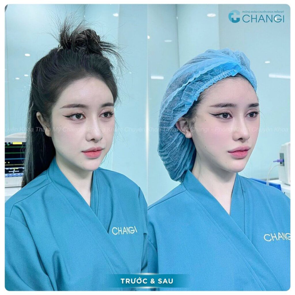 kết quả của căng cơ nội soi