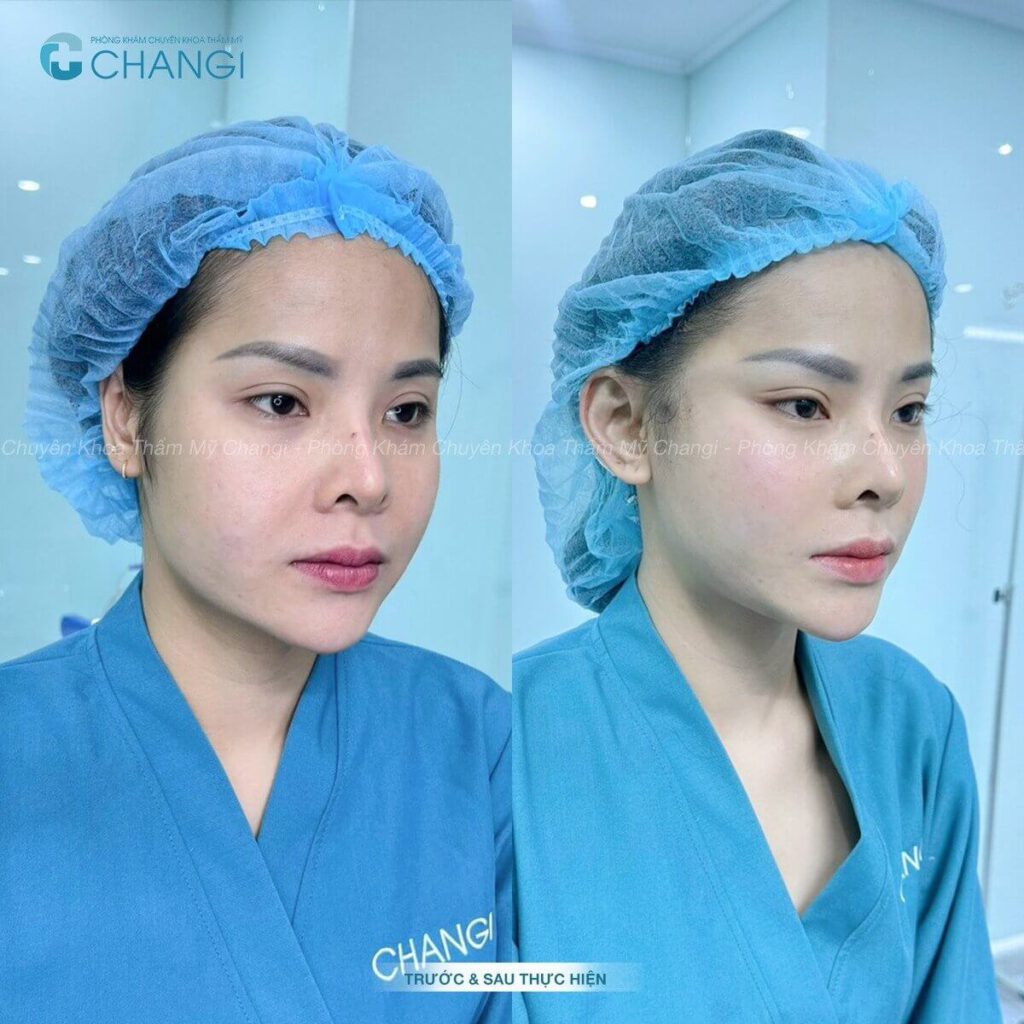 Tác dụng của căng cơ nội soi