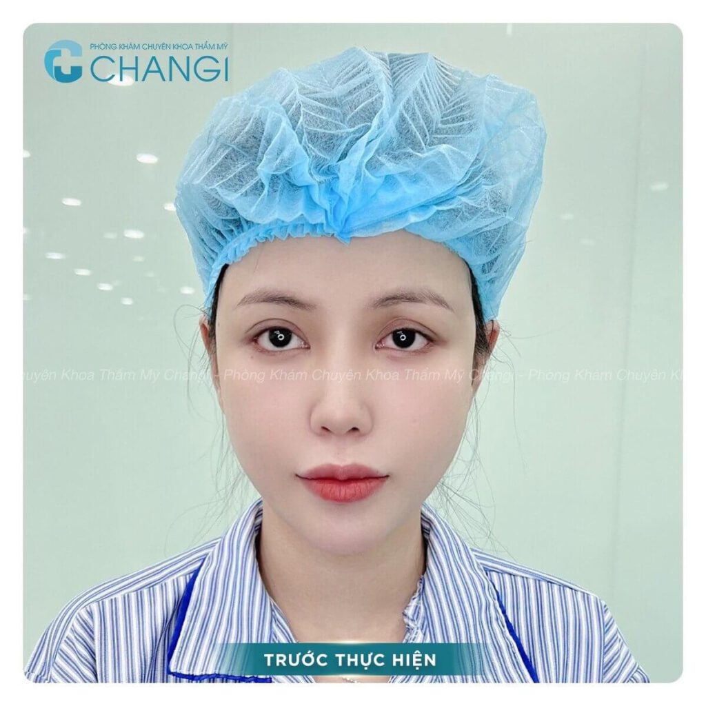 Tai áp sát đầu khiến khuôn mặt không được đẹp