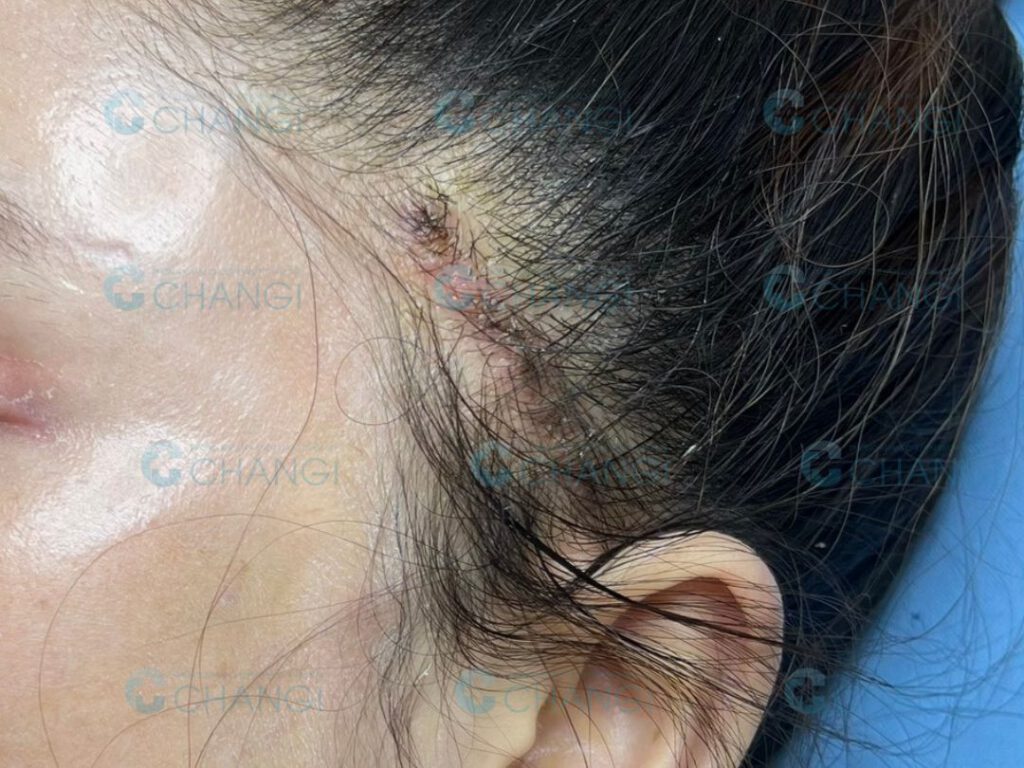 Vết thương căng cơ nội soi