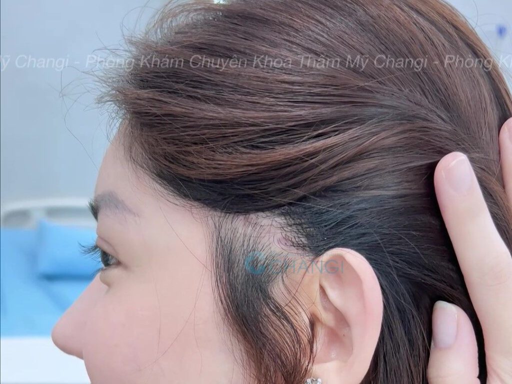 Vết thương căng cơ nội soi sau 2 tháng