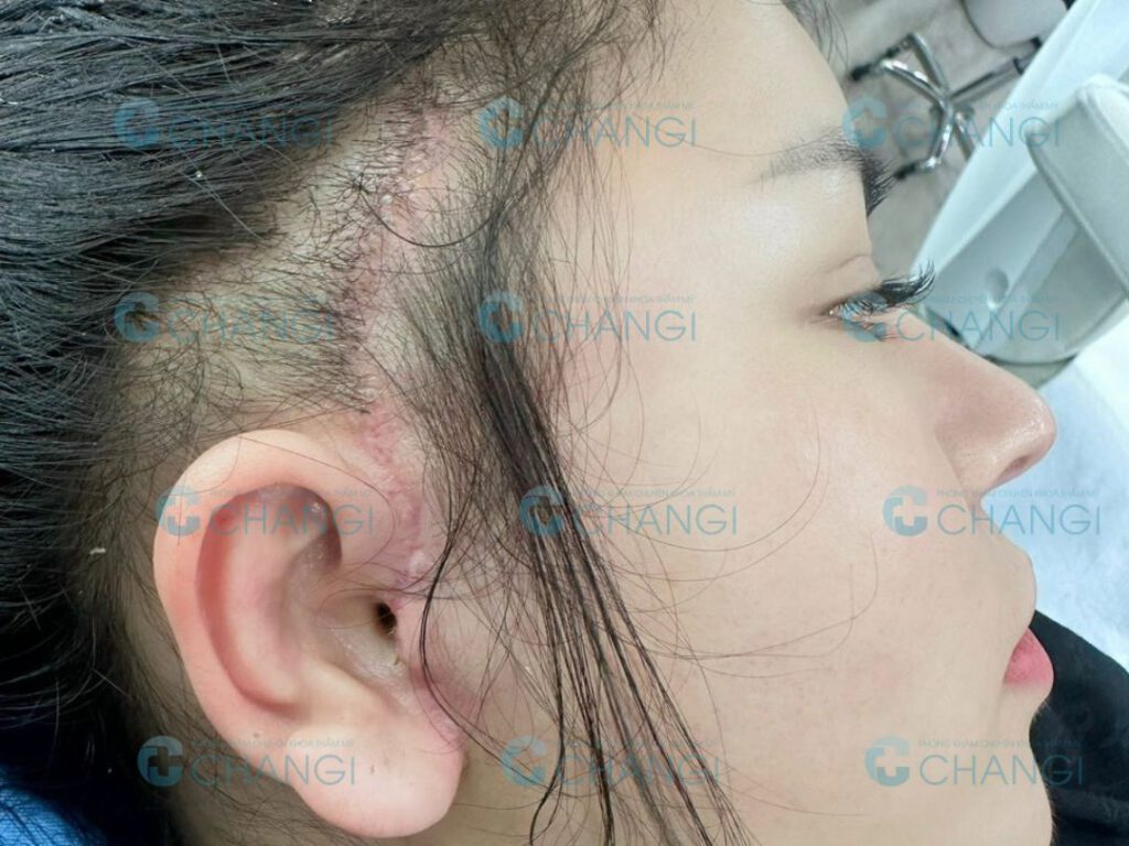 Vết thương thường gặp khi căng da mini plus