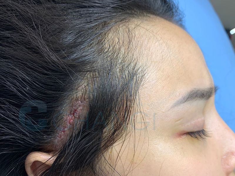 Vị trí vết thương thực hiện căng cơ nội soi