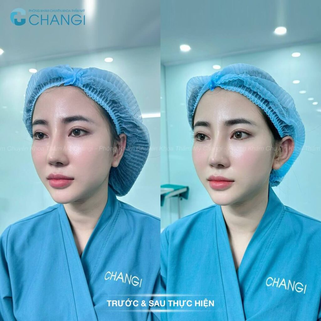 Phẫu thuật tạo hình tai vểnh giúp đẹp hơn