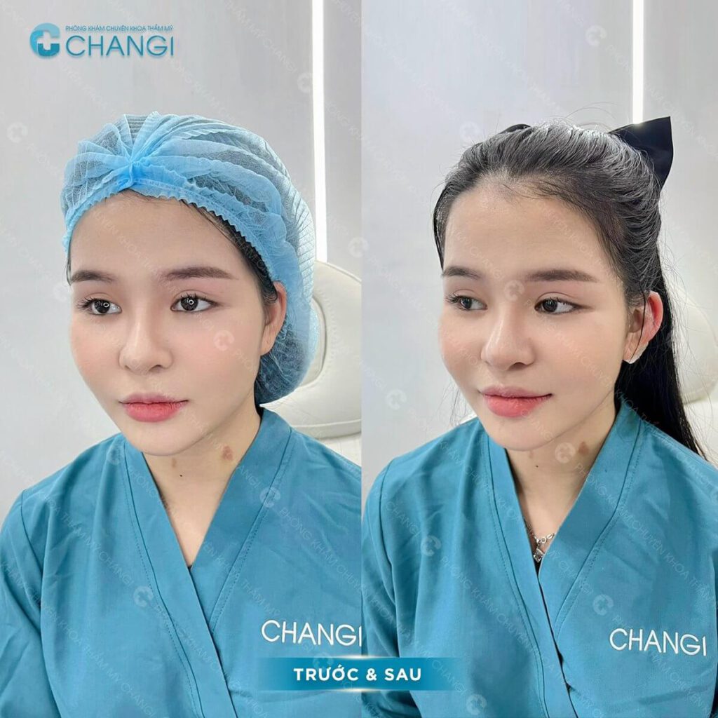 Phẫu thuật tạo hình tai vểnh giúp khuôn mặt tinh anh hơn