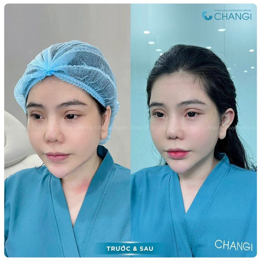 Phẫu thuật tạo hình tai vểnh mang đến dáng tai yêu tinh