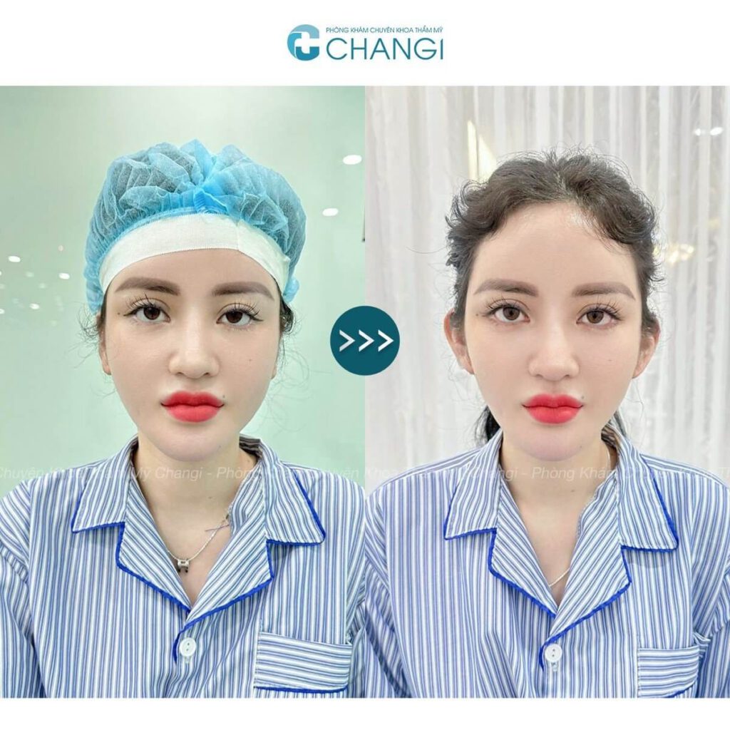 Trước và sau khi tạo hình tai vểnh