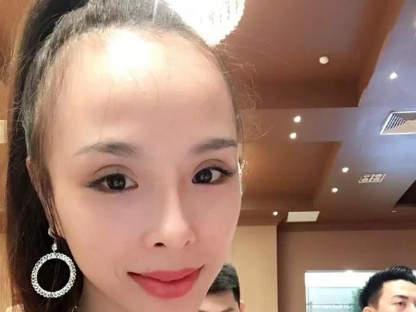 Biểu hiện của trán dồ