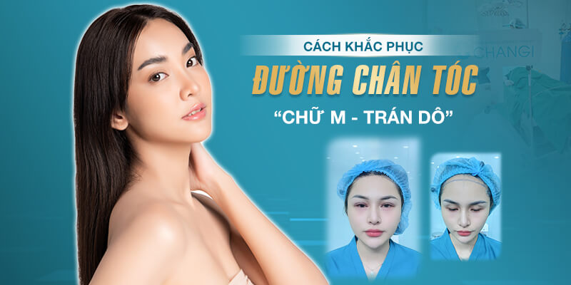 Cách Khắc Phục Đường Chân Tóc Chữ M, Trán Dô