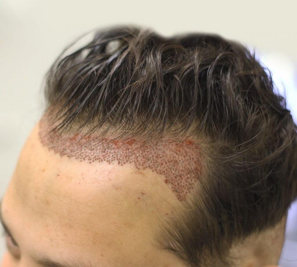 Cấy tóc giúp hạ đường chân tóc