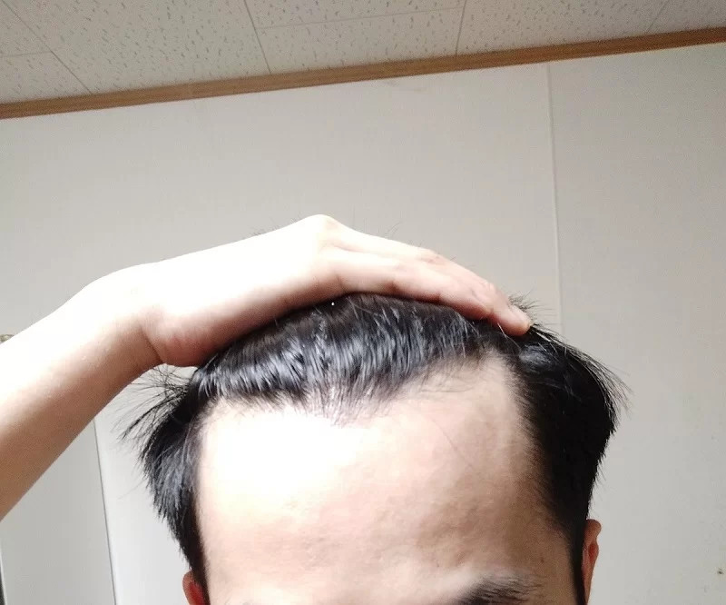 Biểu hiện của đường chân tóc chữ M