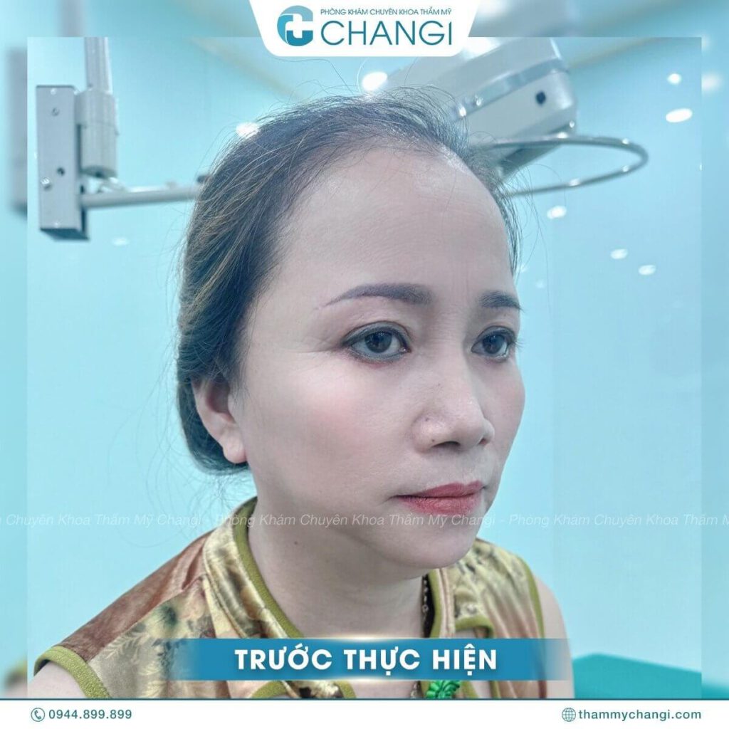 Hiện tượng đường chân tóc quá cao