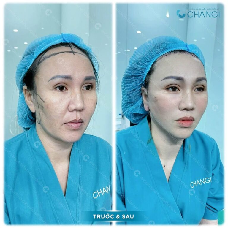 Khách hàng tại Changi sẽ được chiếu tia Plasmamed lạnh nên sẽ hạn chế sưng đau