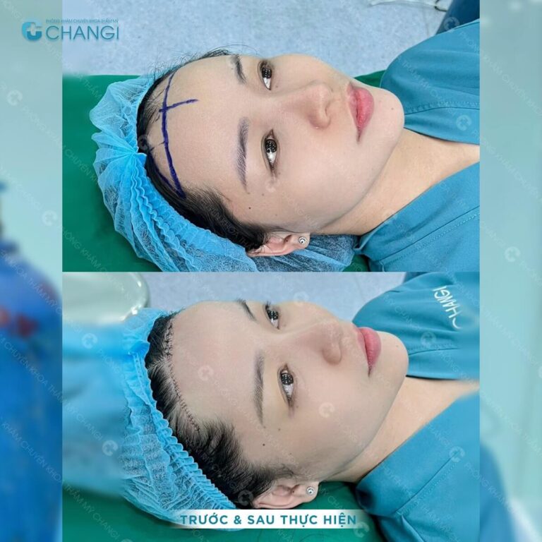 Hạ đường chân tóc là kỹ thuật thẩm mỹ nhằm cải thiện độ dài của trán, cho gương mặt hài hòa cân đối hơn