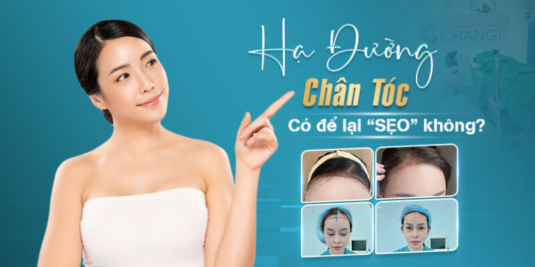 Hạ đường chân tóc có thể để lại sẹo do cơ địa hoặc do bác sĩ tay nghề kém