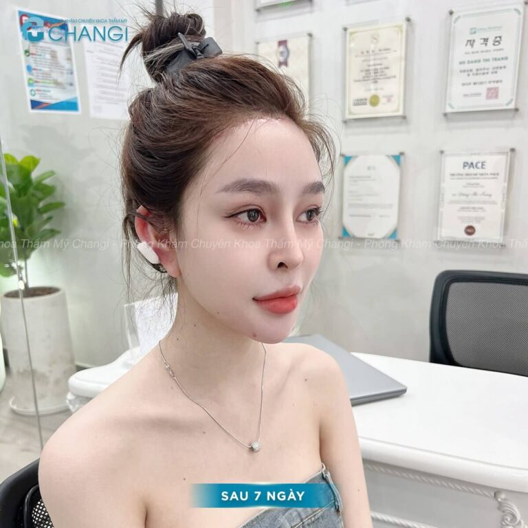 Hạ đường chân tóc đẹp tự nhiên sau 7 ngay, an toàn không rủi ro tại Phòng khám Changi