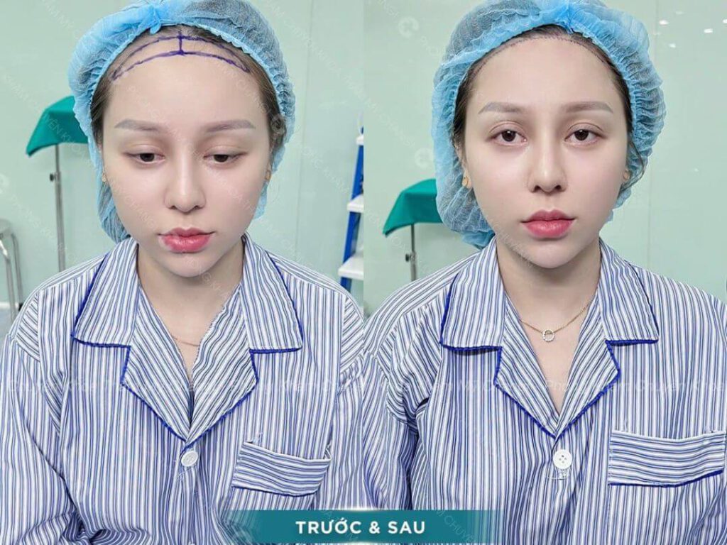 Kết quả sau khi phẫu thuật hạ đường chân tóc