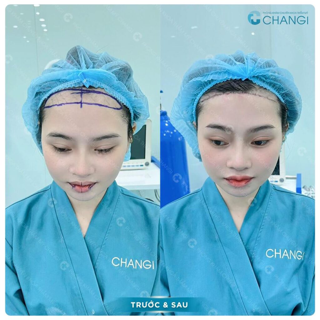 Khắc phục trán chữ M, trán dô với hạ đường chân tóc