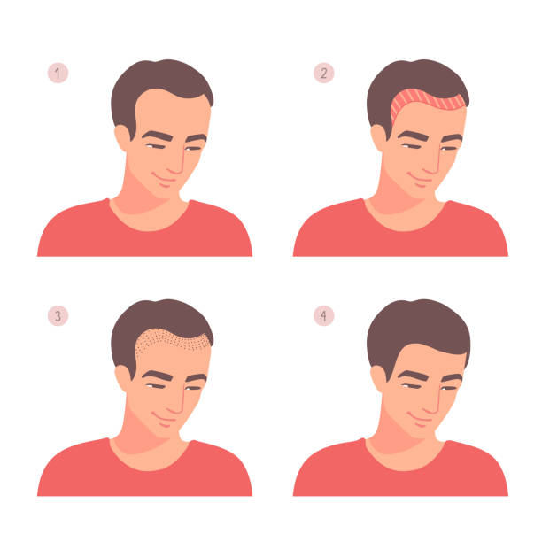 Phẫu thuật hạ đường chân tóc là gì